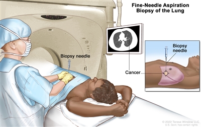 肺细针穿刺活检; drawing shows a patient lying on a table that slides through the computed tomography (CT) machine with an x-ray picture of a cross-section of the lung on a monitor above the patient. 图中还显示了医生使用x光片帮助将活检针穿过胸壁并进入异常肺组织区域. 图示胸腔和肺的侧视图，活检针插入异常组织区域.