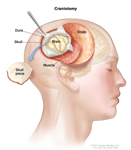 Drawing of a craniotomy showing a section of the scalp that has been pulled back to remove a piece of the skull; the dura covering the brain has been opened to expose the brain. 头皮下的肌肉层也在图中.