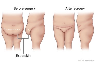 Before-and-after pictures of a panniculectomy, showing the area of the skin that is removed and the location of the resulting scar