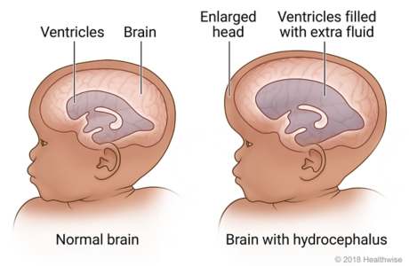 Inside views of normal brain of baby and brain with hydrocephalus that shows enlarged head and ventricles filled with extra fluid.