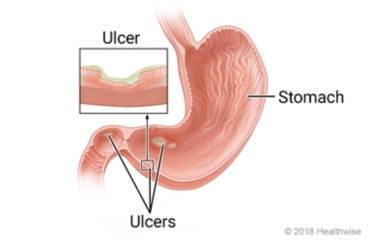 Inside view of a stomach with ulcers, with detail of an ulcer on the stomach wall