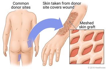 Location of some common sites on the body for donor skin, with detail of meshed skin graft covering wound