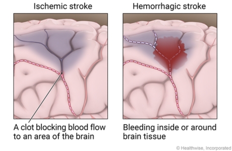 Ischemic stroke showing blood clot blocking blood flow to area of brain and a hemorrhagic stroke showing bleeding inside or around brain tissue.