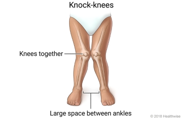 Knock-knees, showing the knees together and a large space between the ankles