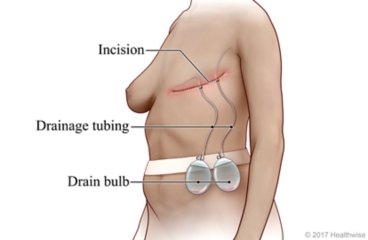 Post-mastectomy incision with drains