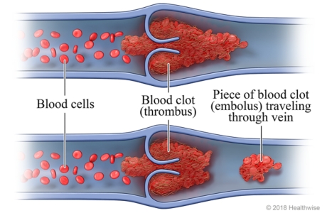 Cross-section of a vein, showing blood cells, a blood clot (thrombus), and a piece of the blood clot (embolus) that has broken off the thrombus and is moving through the vein.