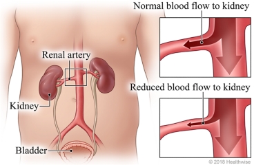 Anatomy of renal arteries, kidneys, and bladder, with detail of artery showing normal versus reduced blood flow.