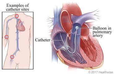Examples of catheter sites with cross section of heart showing catheter and inflated balloon