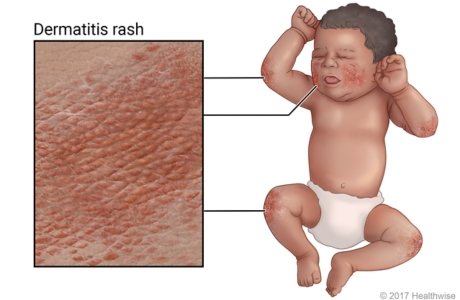 Baby with eczema, showing rash on elbows, cheeks, and knees.