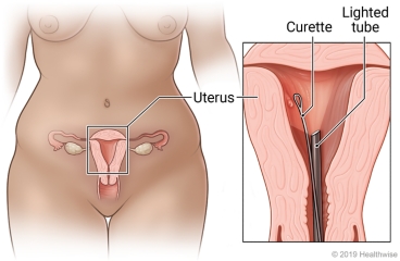 Female pelvic organs in lower belly, with detail of uterus showing curette and lighted tube inside uterus