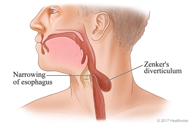 Esophagus showing a weak spot that causes the Zenkers diverticulum pouch
