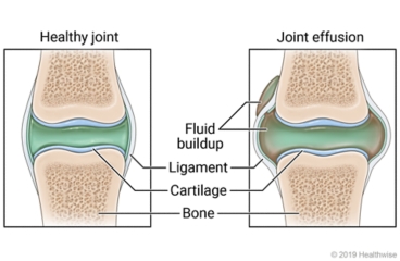 Fluid found in a healthy joint, compared to a joint with fluid buildup