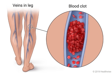 Back of person's legs showing veins in leg, with detail of blood clot inside vein.