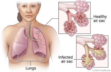 Lungs in chest showing airways, with detail of healthy air sac and infected air sac