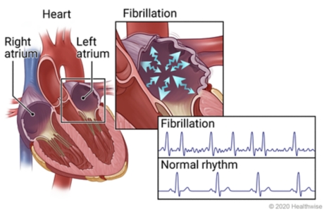 Right and left atria of heart with details showing fibrillation in an atrium, and EKG patterns of fibrillation and normal rhythm.