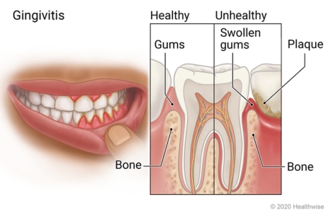 Mouth with swollen gums, with detail of healthy tooth and gums and of unhealthy tooth showing plaque on tooth and swollen gums.