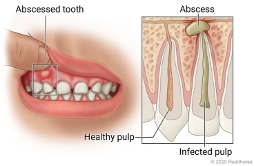 Child's mouth with abscessed tooth and pocket of pus in gums near it, with inside detail of tooth with healthy pulp and abscessed tooth with infected pulp.