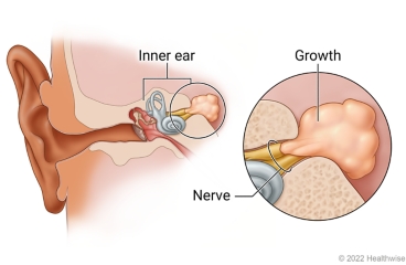 Parts of the ear, showing a growth on nerve to inner ear.