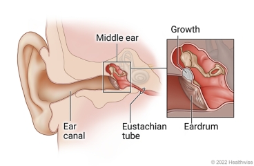 Anatomy of child's ear, showing ear canal, middle ear, and eustachian tube, with detail of growth behind eardrum in middle ear.