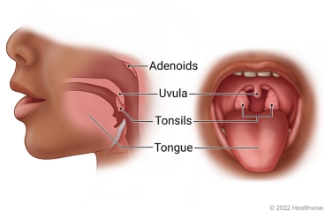 Side and open-mouth views of child's mouth and throat, showing adenoids, uvula, tonsils, and tongue.