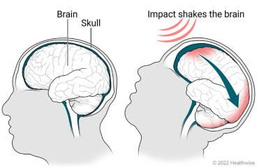 Healthy brain in skull, and a brain shaken in skull and injured due to an impact injury.