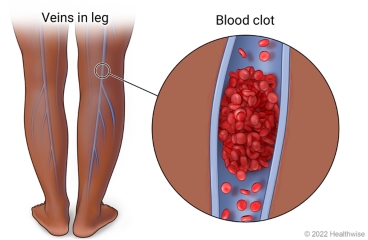 Back of legs showing deep veins, with detail of a blood clot formed in a vein.