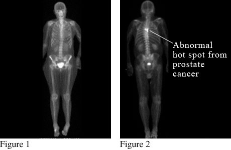 Image of a bone scan showing prostate cancer