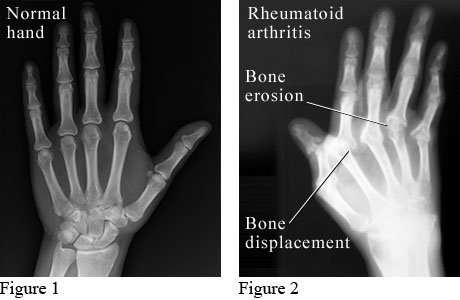 X-ray images showing a normal hand and a hand with rheumatoid arthritis