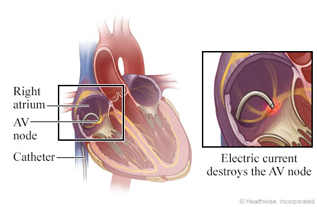 Location of catheter in the heart, with detail of electric current destroying AV node.