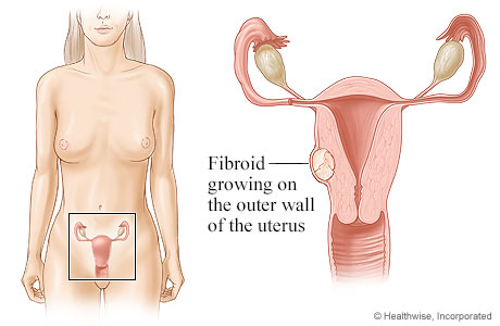Location of uterus and ovaries, with detail of fibroid growing on outer wall of uterus