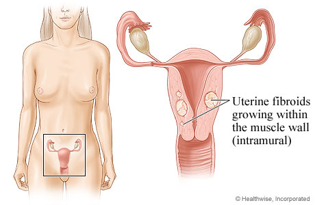 Location of uterus and ovaries, with detail of fibroid growing in uterine wall