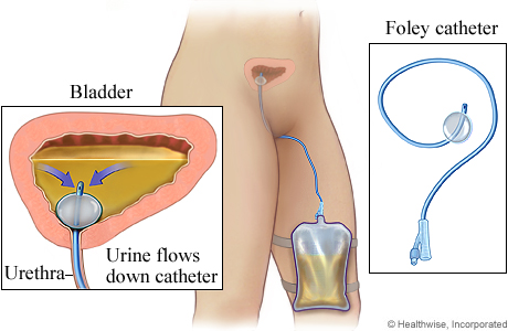 Indwelling Foley catheter for women