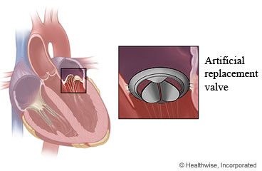 Artificial replacement valve and where it fits in the heart