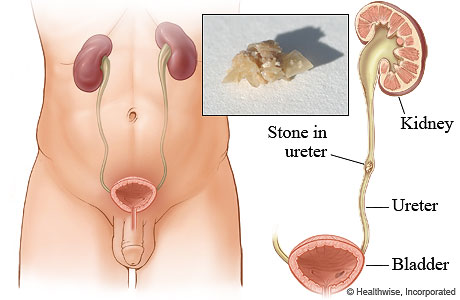 A kidney stone in the ureter