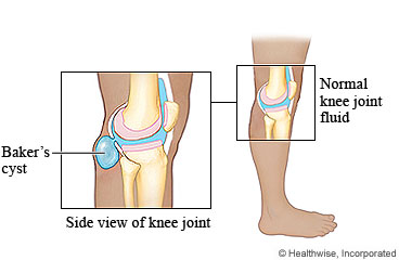 Side view of a knee with a Baker's cyst and a normal knee joint