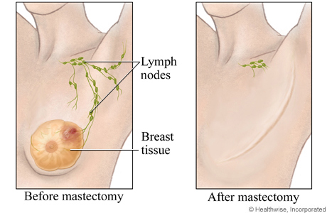 Before and after a mastectomy