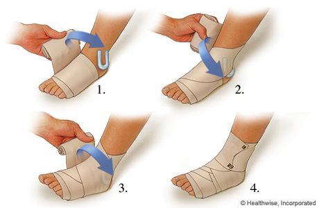 How to apply a compression wrap for a sprained ankle.