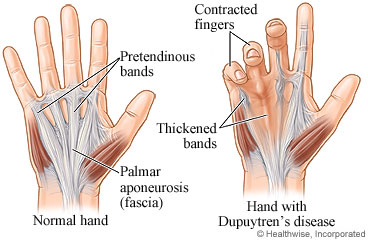 Normal hand and hand with Dupuytren's disease.