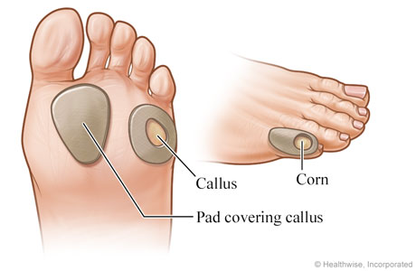 Pads on corn on little toe and on calluses on bottom of foot