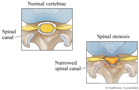 Picture of a normal spinal canal and a narrowed spinal canal (cross section)