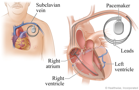 Location of pacemaker and how it connects to the heart.