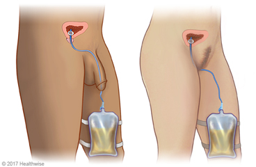 Male and female anatomy with indwelling catheter in place