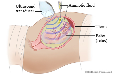 Picture of how an amniocentesis is done