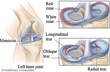 Pictures of meniscus tear