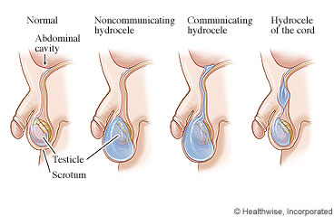 Normal testicle and testicles with hydroceles