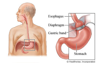 Esophagus and stomach, with a detail of the esophagus, diaphragm, gastric band, and stomach