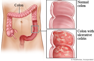 A normal colon and ulcerative colitis