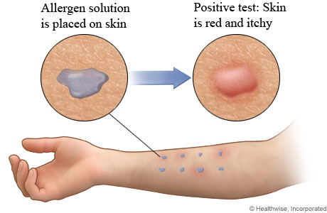 Allergen solution on arm and positive result