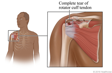 Location of rotator cuff in shoulder, with detail of complete tear of rotator cuff tendon