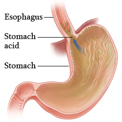 Acid in the stomach and esophagus